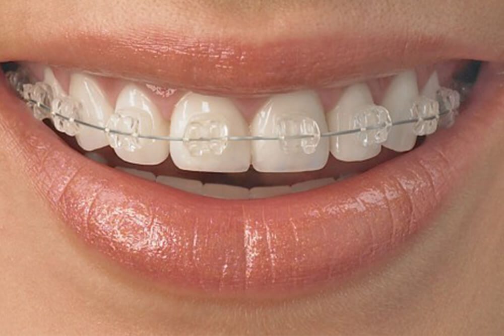 crystal braces ortho services Orthodontics Treatment