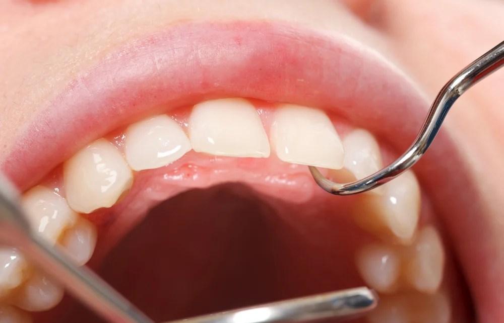 dentist can resolve the harm seamlessly e1678105024842 Dental Veneers