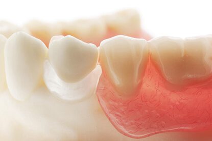 انواع اطقم الأسنان