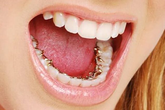 التقويم الداخلي ( اللساني) - أفضل علاج تقويم أسنان في دبي
