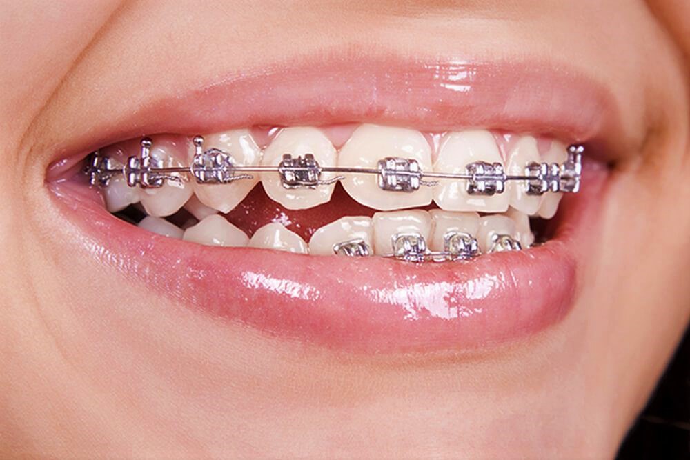 Can Braces Really Change Your Face Shape