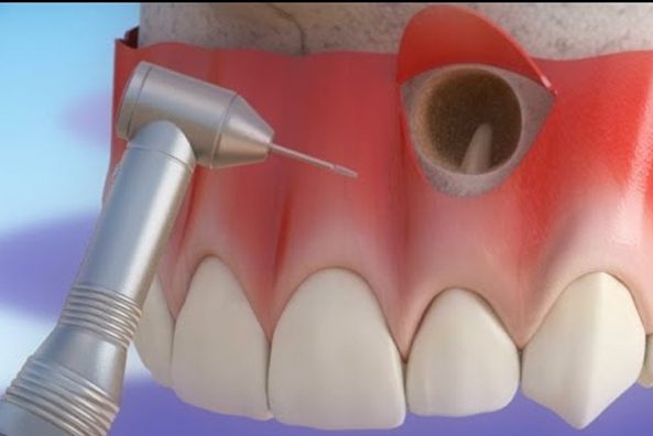 apicoecotomy oral Oral and Maxillofacial Surgery