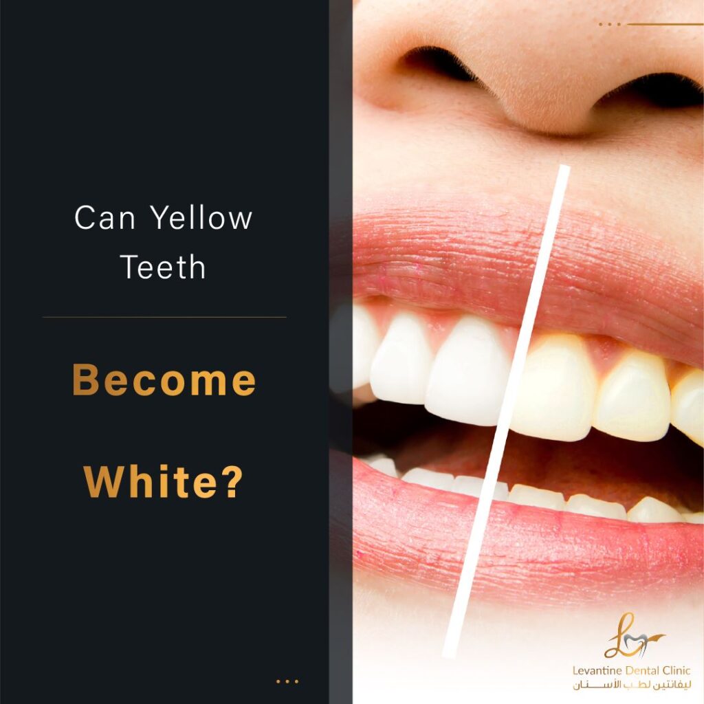 Can Yellow Teeth Become White