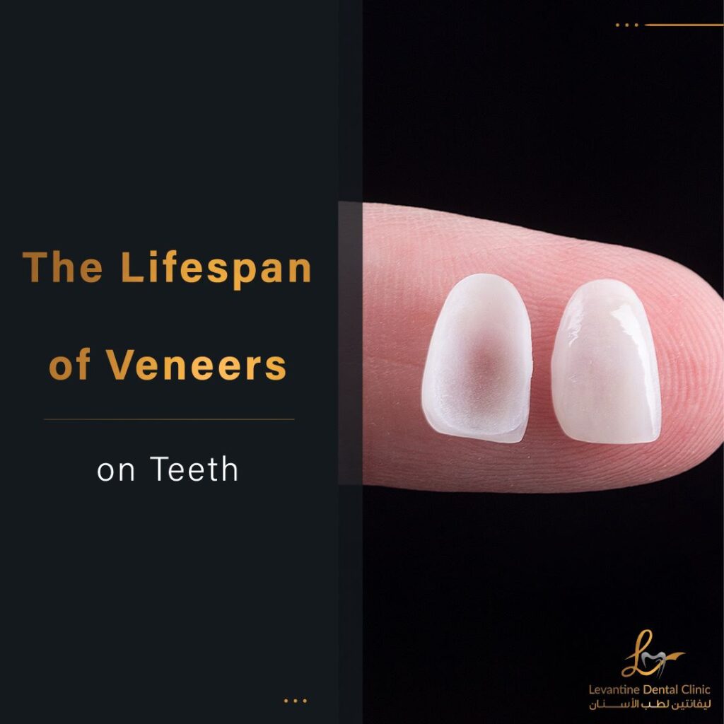 The life span of dental veneers