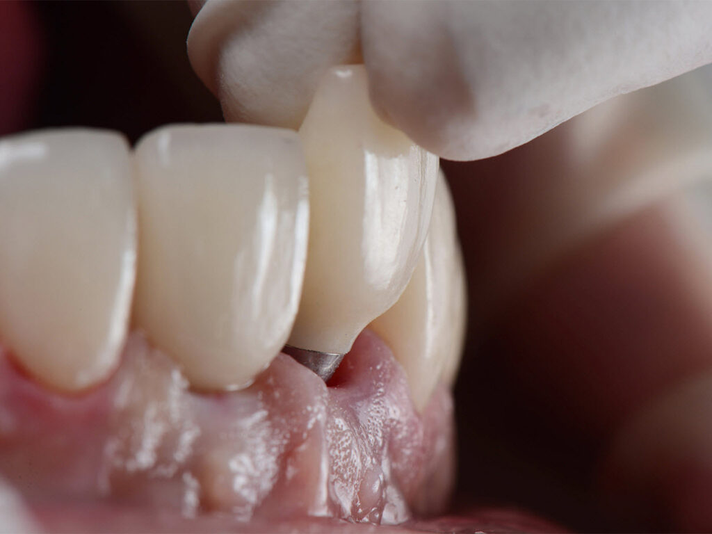 dental implants - best-dental-clinic-in-dubai