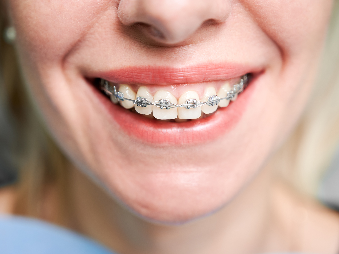 My Teeth Yellow After Braces