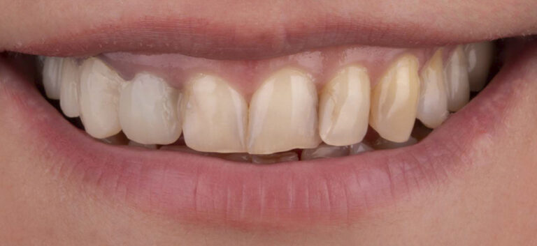 Hollywood smile - makeover -before
