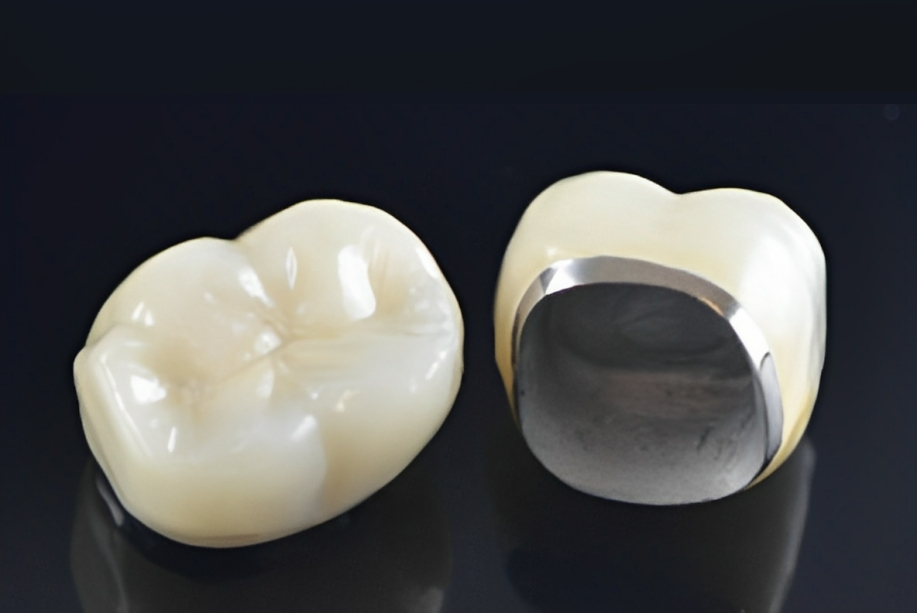 dental metal crown Dental Crowns