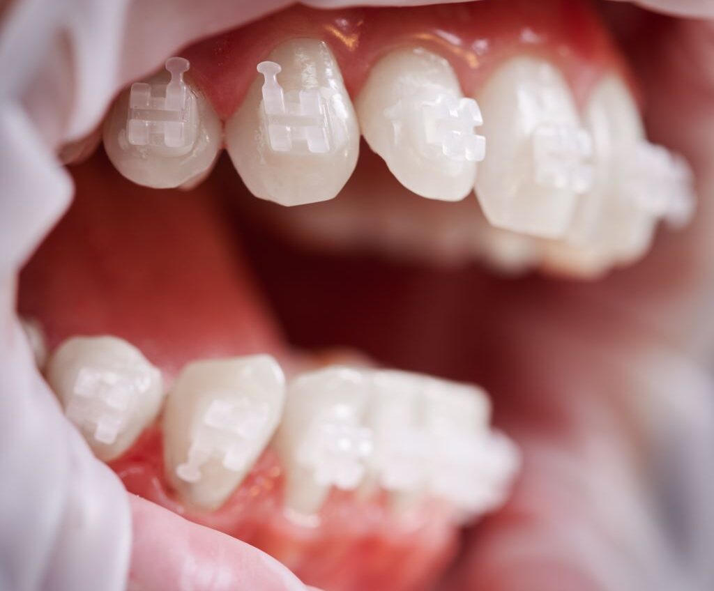 Metal Braces Near You - Best Orthodontists in Abu Dhabi