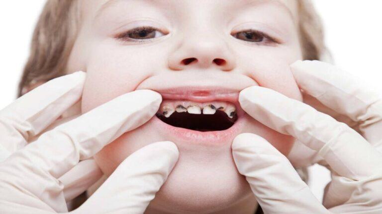 baby tooth decay