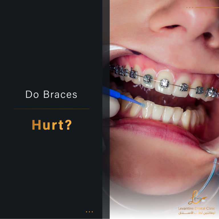 Do Braces Hurt Understanding the Truth about Dental Braces