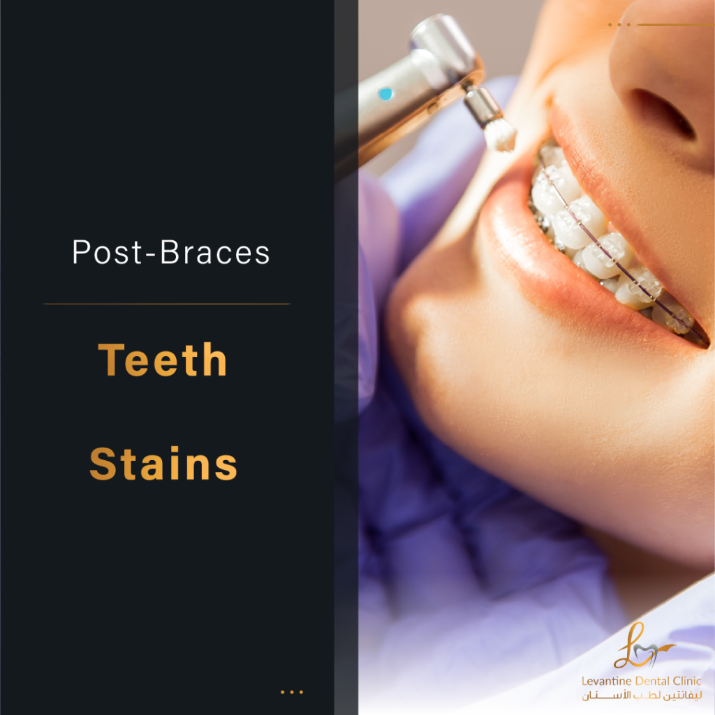 Post-Braces teeth stains