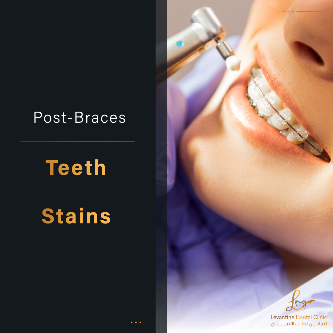 Unveiling The Mystery Of PostBraces Teeth Stains Causes, Treatments