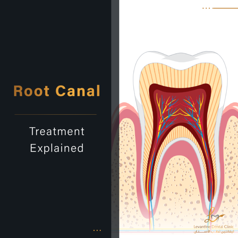 Root Canal treatment explained