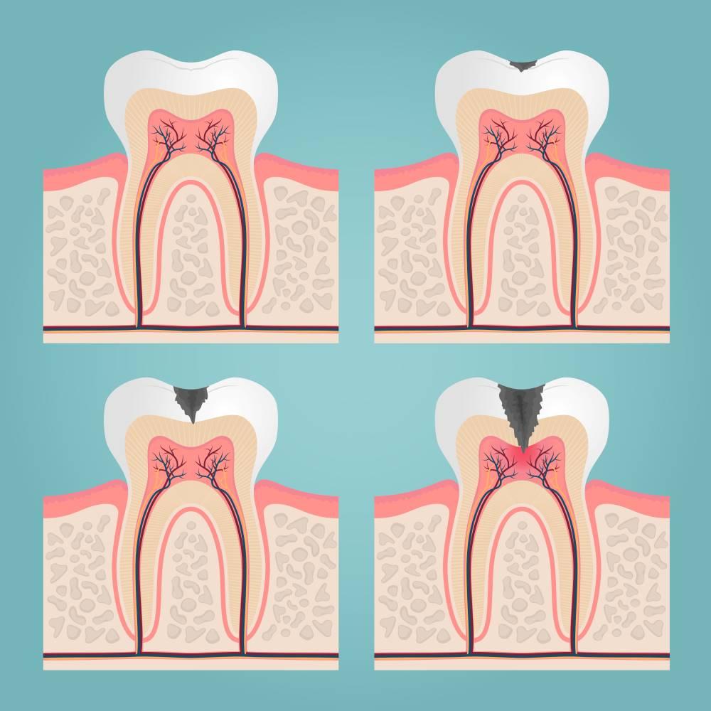 تسوس الأسنان و أمراض اللثة