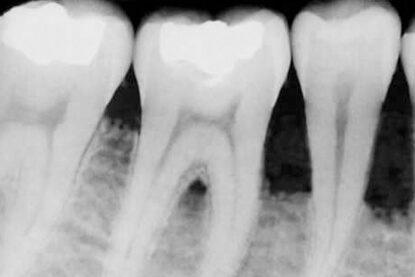 الأشعة السينية لتحديد تجاويف الأسنان