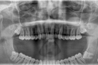 denta-x-ray-for-oral-health