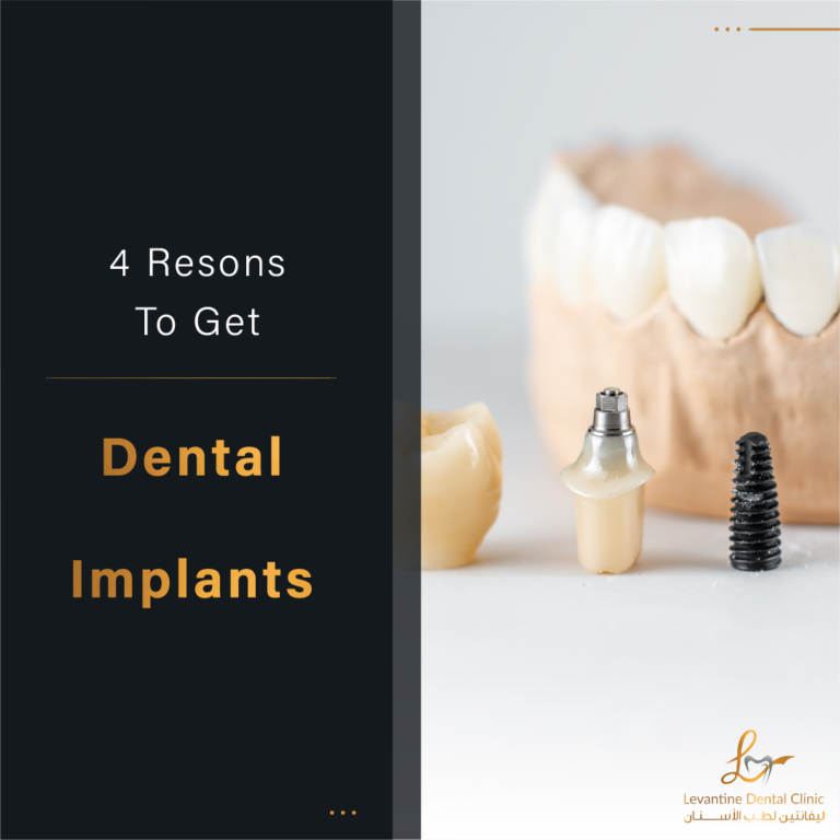 4 Reasons to Get Dental Implants