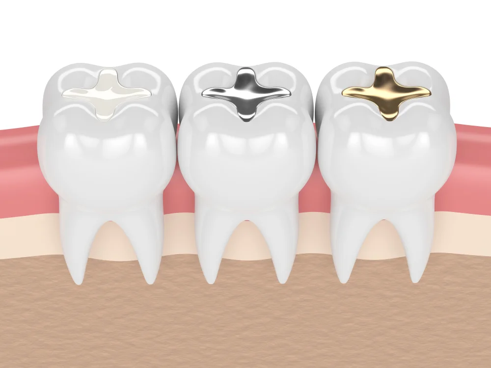 diffrance of Dental Fillings in Dubai What is Porcelain Fillings? Every thing you need to know