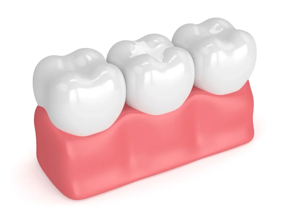Difference-between-Composite-and-Porcelain-Fillings